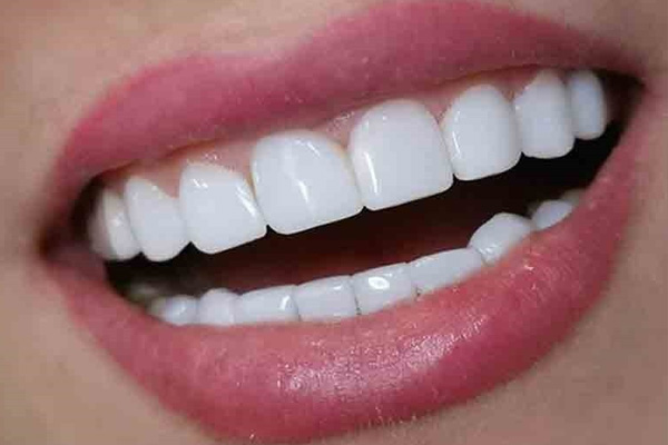  زیبایی، بلیچینگ، لمینت و کمپوزیت